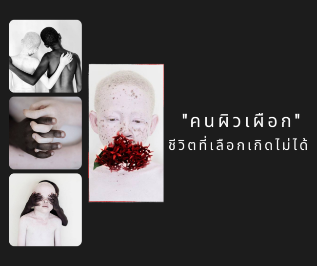 คนผิวเผือก